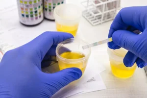 Ce înseamnă glucoza mare în urină?