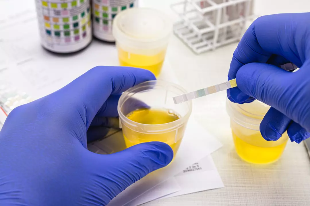 Prezența glucozei în urină